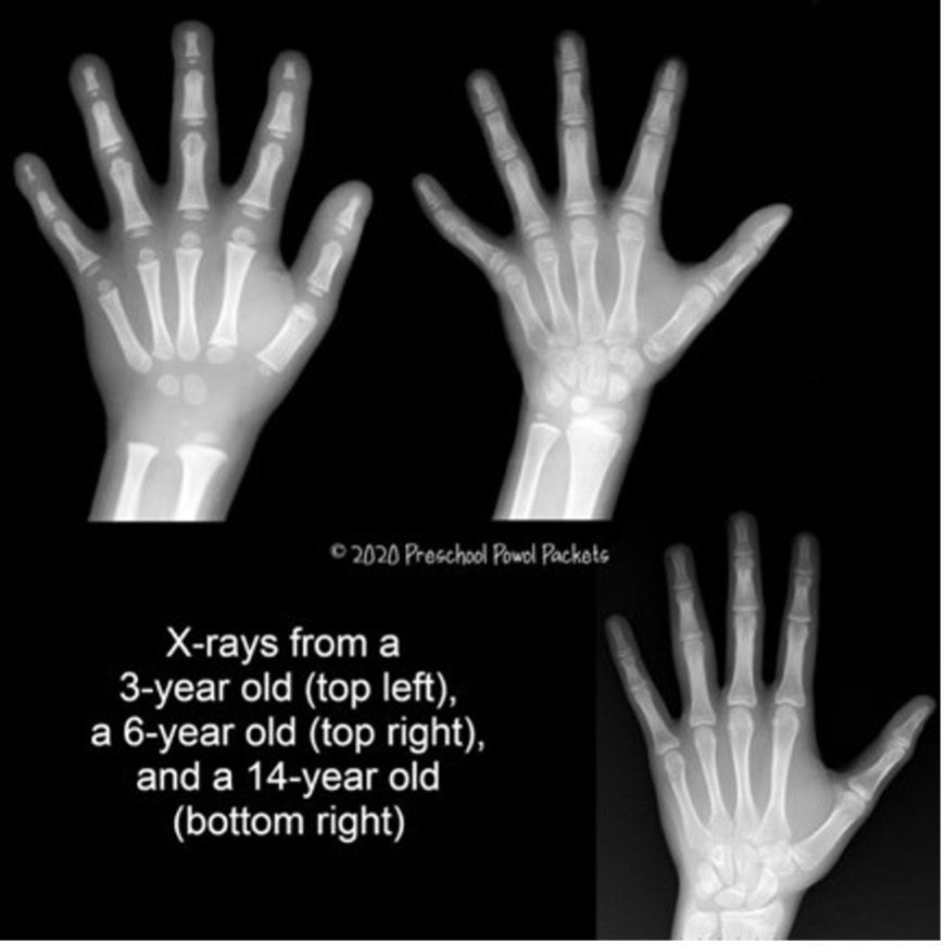 x-rays of children's hands